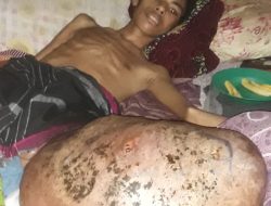 Raymundus Derita Tumor Ganas Ancam Nyawa , Keluarga Butuh Uluran Tangan Donatur