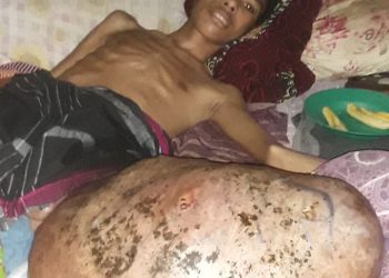 Raymundus Derita Tumor Ganas Ancam Nyawa , Keluarga Butuh Uluran Tangan Donatur