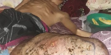 Raymundus Derita Tumor Ganas Ancam Nyawa , Keluarga Butuh Uluran Tangan Donatur