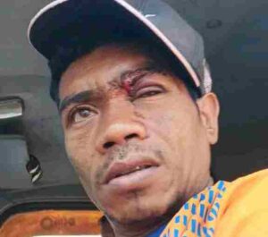 Oknum  Aparat Desa Nubaboli Diduga Aniaya Mikhael Pito Koli